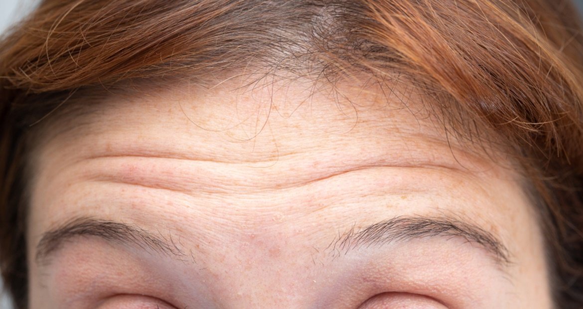 Flacidez Facial